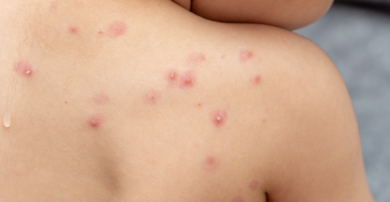 Registra México mil 627 casos de viruela del mono