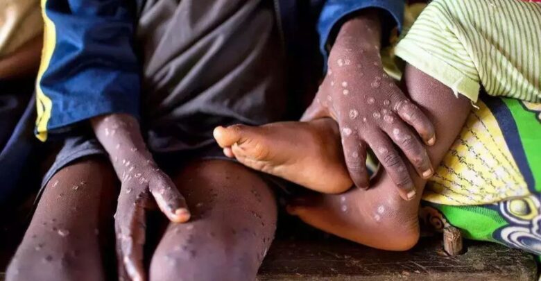 OMS declara emergencia mundial por brote de mpox