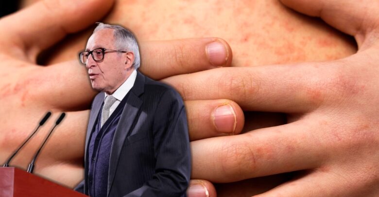 Kershenobich asegura que el brote de sarampión en Chihuahua está bajo control Kershenobich asegura que el brote de sarampión en Chihuahua está bajo control
