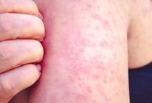 México suma 31 muertes por sarampión y casi 10 mil casos