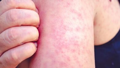 México suma 31 muertes por sarampión y casi 10 mil casos