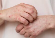 Suspenden clases presenciales en Jalisco y Aguascalientes por brote de sarampión