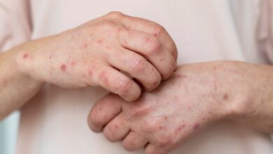 Suspenden clases presenciales en Jalisco y Aguascalientes por brote de sarampión