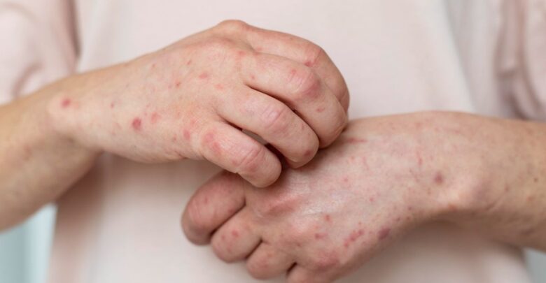 Suspenden clases presenciales en Jalisco y Aguascalientes por brote de sarampión